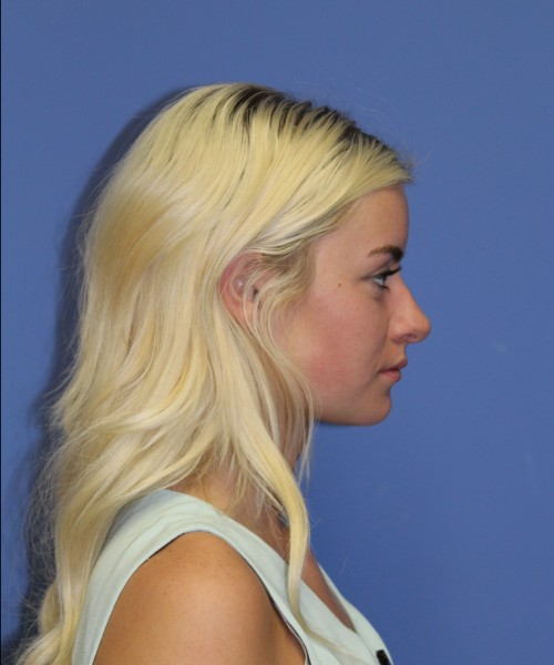 Rhinoplasty 1589 – Click HERE for more views before photo. Individual results may vary.