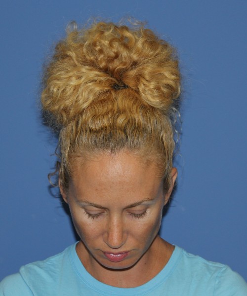 Rhinoplasty 1590 – Click HERE for more views after photo. Individual results may vary.