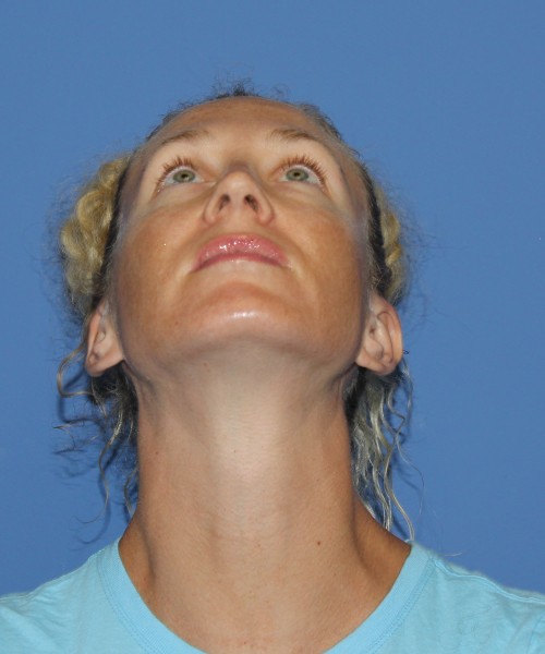 Rhinoplasty 1590 – Click HERE for more views after photo. Individual results may vary.