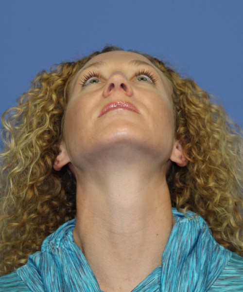 Rhinoplasty 1590 – Click HERE for more views before photo. Individual results may vary.