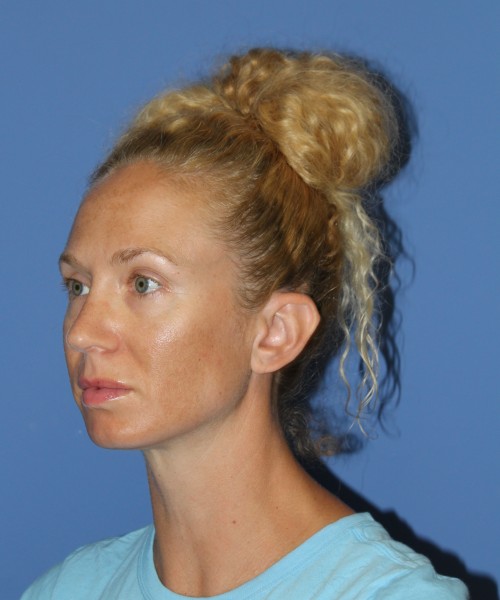 Rhinoplasty 1590 – Click HERE for more views after photo. Individual results may vary.