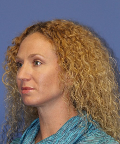 Rhinoplasty 1590 – Click HERE for more views before photo. Individual results may vary.