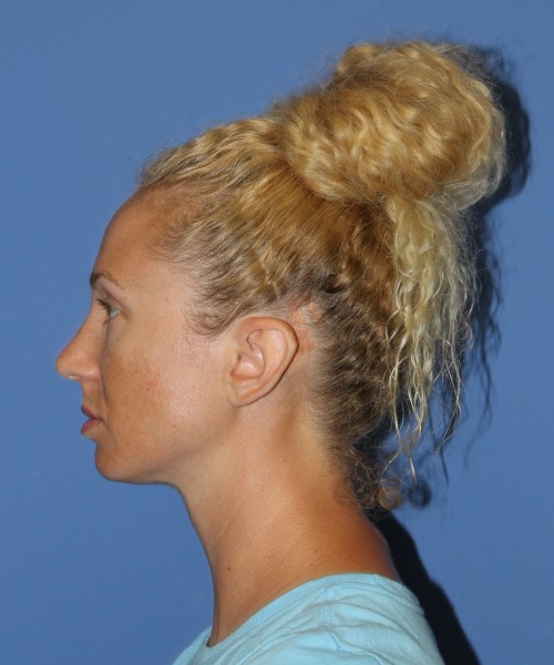 Rhinoplasty 1590 – Click HERE for more views after photo. Individual results may vary.