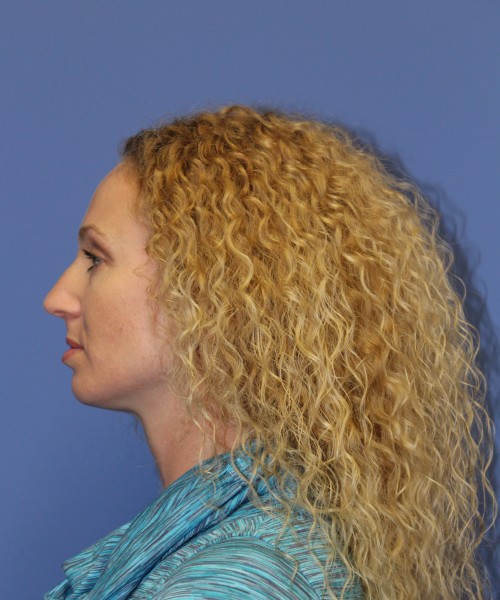 Rhinoplasty 1590 – Click HERE for more views before photo. Individual results may vary.