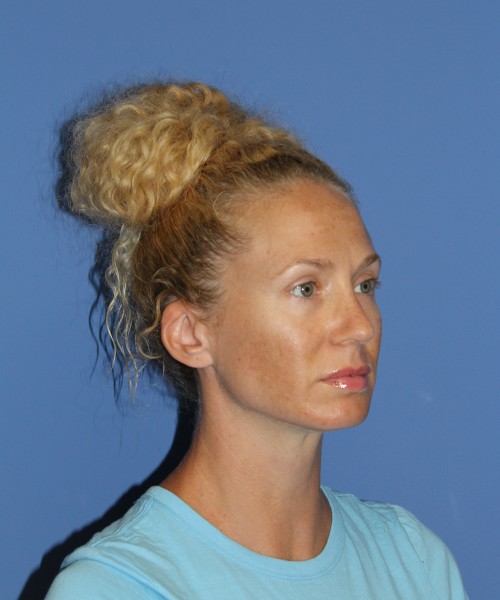 Rhinoplasty 1590 – Click HERE for more views after photo. Individual results may vary.