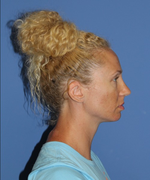 Rhinoplasty 1590 – Click HERE for more views after photo. Individual results may vary.