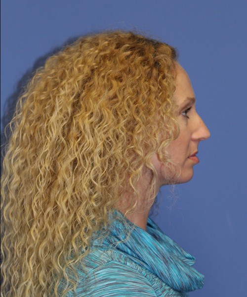 Rhinoplasty 1590 – Click HERE for more views before photo. Individual results may vary.