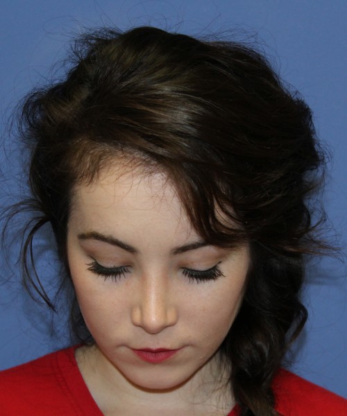 Rhinoplasty 1591 – Click HERE for more views after photo. Individual results may vary.