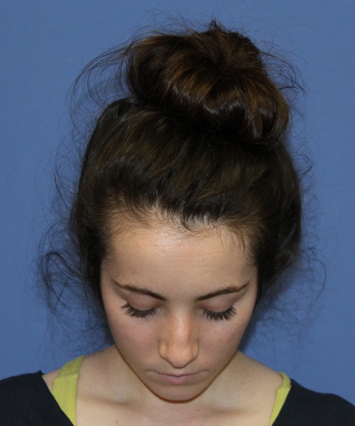 Rhinoplasty 1591 – Click HERE for more views before photo. Individual results may vary.