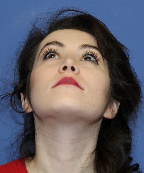 Rhinoplasty 1591 – Click HERE for more views after photo. Individual results may vary.