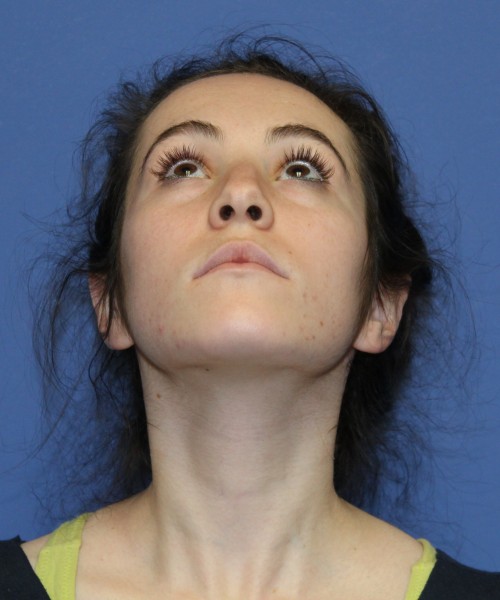Rhinoplasty 1591 – Click HERE for more views before photo. Individual results may vary.