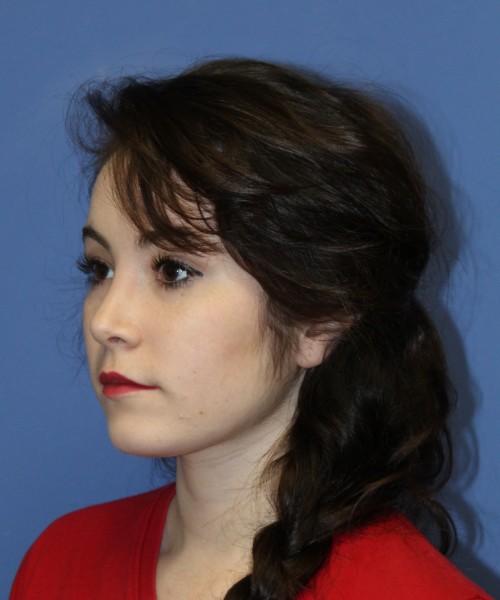 Rhinoplasty 1591 – Click HERE for more views after photo. Individual results may vary.