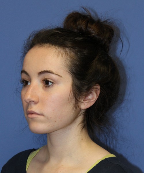 Rhinoplasty 1591 – Click HERE for more views before photo. Individual results may vary.