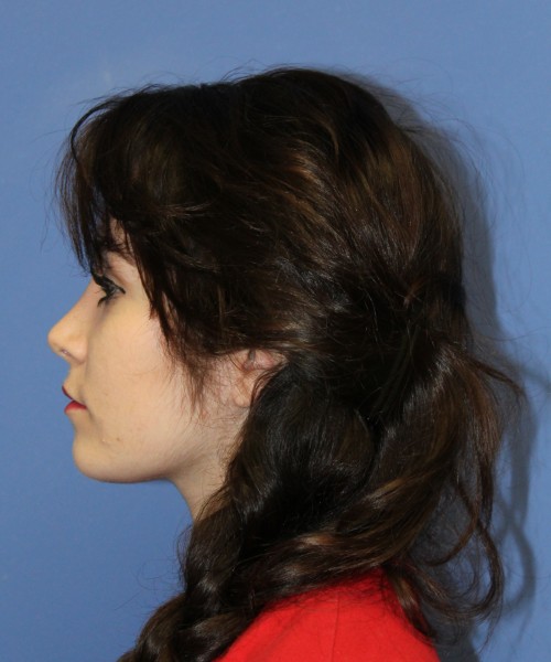 Rhinoplasty 1591 – Click HERE for more views after photo. Individual results may vary.
