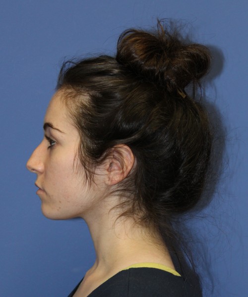 Rhinoplasty 1591 – Click HERE for more views before photo. Individual results may vary.