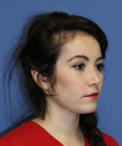 Rhinoplasty 1591 – Click HERE for more views after photo. Individual results may vary.