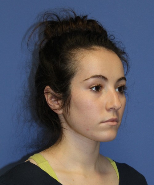 Rhinoplasty 1591 – Click HERE for more views before photo. Individual results may vary.