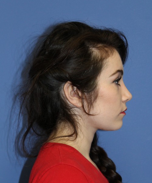 Rhinoplasty 1591 – Click HERE for more views after photo. Individual results may vary.