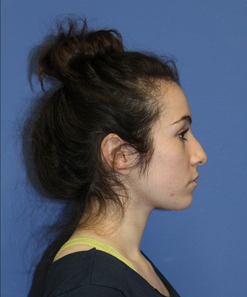 Rhinoplasty 1591 – Click HERE for more views before photo. Individual results may vary.