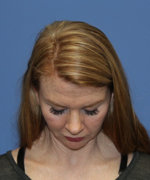 Rhinoplasty 1592 – Click HERE for more views before photo. Individual results may vary.