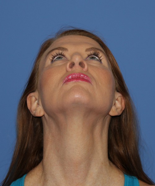 Rhinoplasty 1592 – Click HERE for more views after photo. Individual results may vary.