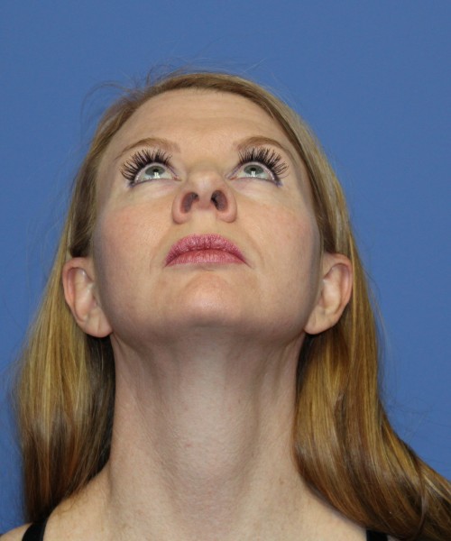 Rhinoplasty 1592 – Click HERE for more views before photo. Individual results may vary.