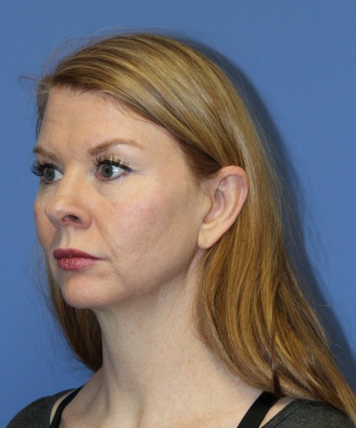 Rhinoplasty 1592 – Click HERE for more views before photo. Individual results may vary.