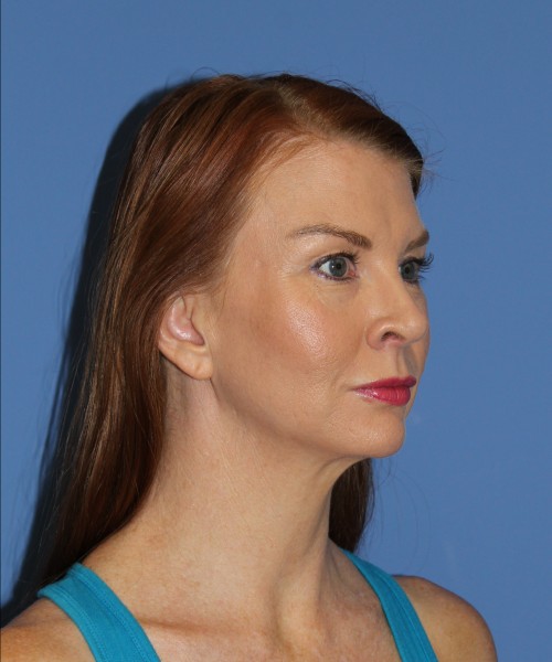 Rhinoplasty 1592 – Click HERE for more views after photo. Individual results may vary.