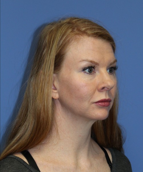 Rhinoplasty 1592 – Click HERE for more views before photo. Individual results may vary.