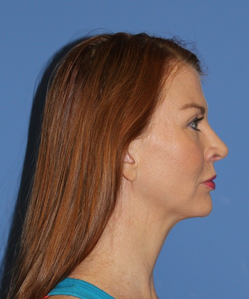 Rhinoplasty 1592 – Click HERE for more views after photo. Individual results may vary.