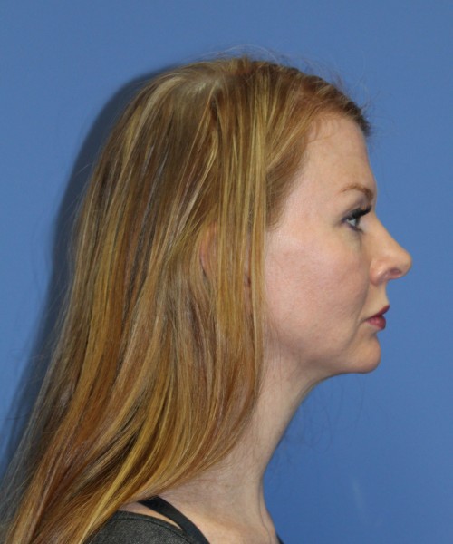 Rhinoplasty 1592 – Click HERE for more views before photo. Individual results may vary.