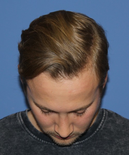 Rhinoplasty 1593 – Click HERE for more views after photo. Individual results may vary.