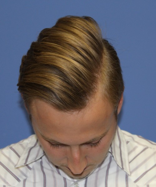 Rhinoplasty 1593 – Click HERE for more views before photo. Individual results may vary.