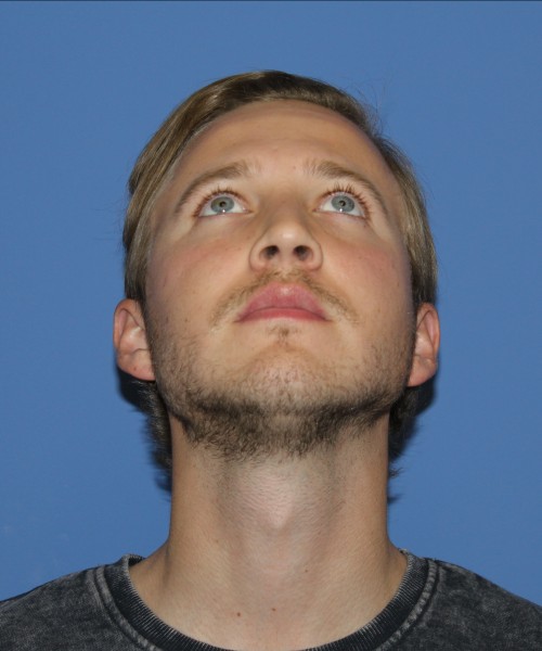 Rhinoplasty 1593 – Click HERE for more views after photo. Individual results may vary.