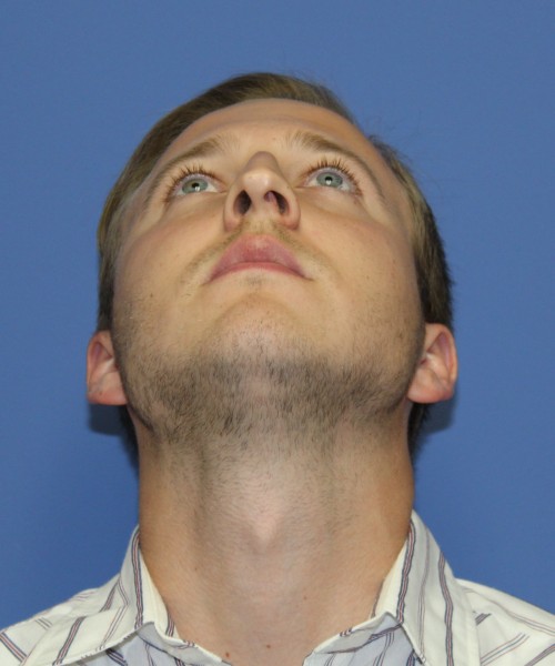 Rhinoplasty 1593 – Click HERE for more views before photo. Individual results may vary.