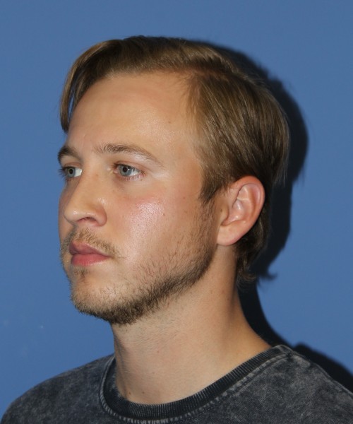Rhinoplasty 1593 – Click HERE for more views after photo. Individual results may vary.