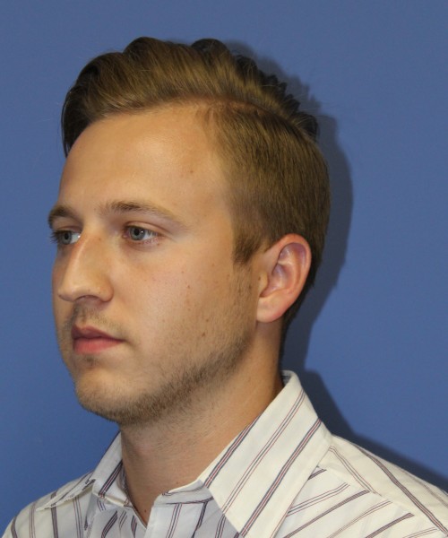 Rhinoplasty 1593 – Click HERE for more views before photo. Individual results may vary.