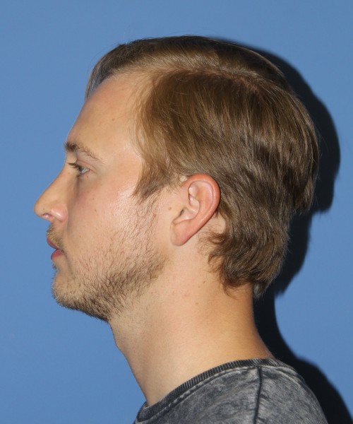 Rhinoplasty 1593 – Click HERE for more views after photo. Individual results may vary.
