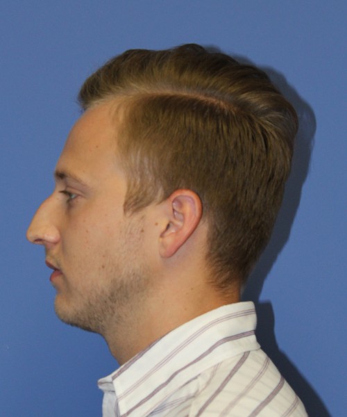Rhinoplasty 1593 – Click HERE for more views before photo. Individual results may vary.