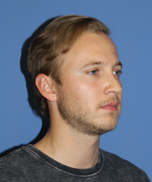 Rhinoplasty 1593 – Click HERE for more views after photo. Individual results may vary.