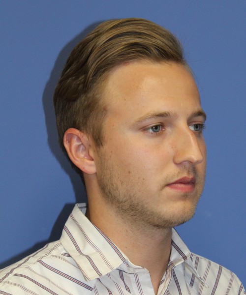 Rhinoplasty 1593 – Click HERE for more views before photo. Individual results may vary.