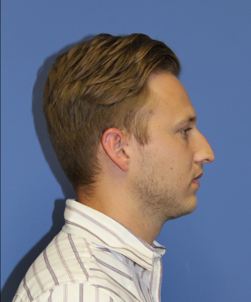 Rhinoplasty 1593 – Click HERE for more views before photo. Individual results may vary.