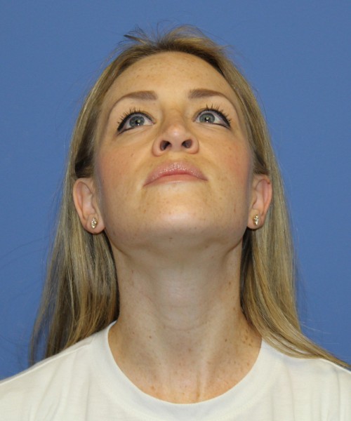 Rhinoplasty 1594 – Click HERE for more views after photo. Individual results may vary.