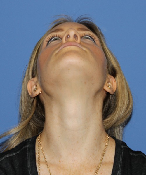 Rhinoplasty 1594 – Click HERE for more views before photo. Individual results may vary.