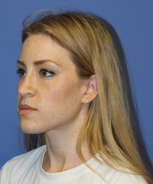 Rhinoplasty 1594 – Click HERE for more views after photo. Individual results may vary.
