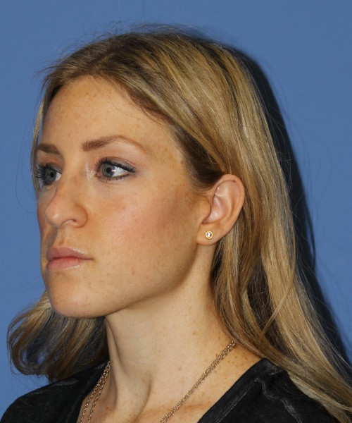 Rhinoplasty 1594 – Click HERE for more views before photo. Individual results may vary.