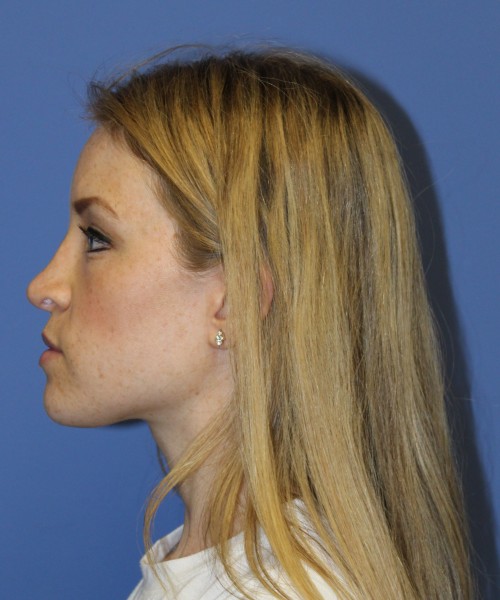 Rhinoplasty 1594 – Click HERE for more views after photo. Individual results may vary.