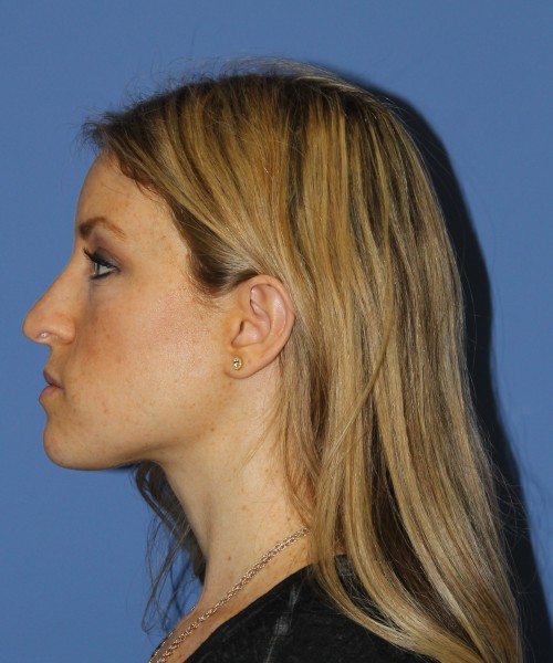 Rhinoplasty 1594 – Click HERE for more views before photo. Individual results may vary.