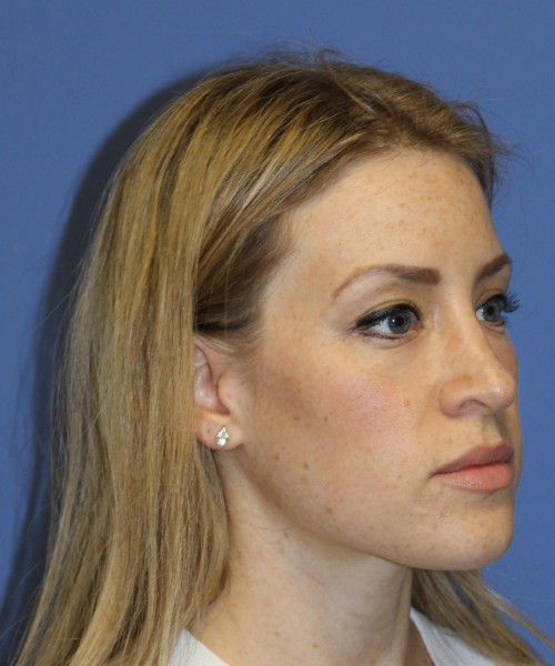 Rhinoplasty 1594 – Click HERE for more views after photo. Individual results may vary.
