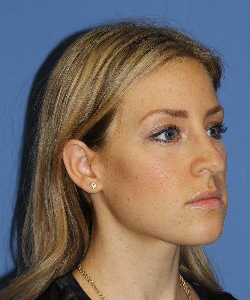 Rhinoplasty 1594 – Click HERE for more views before photo. Individual results may vary.